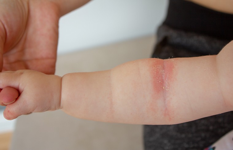 Viêm da dị ứng có thể gây phát ban ở nếp gấp tay của trẻ