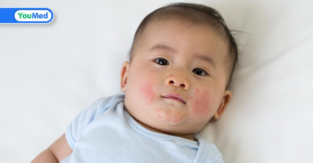 Viêm da dị ứng ở trẻ em: nguyên nhân, triệu chứng và cách điều trị