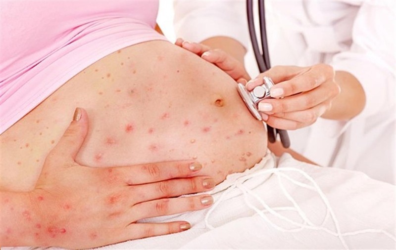 Hội chứng thủy đậu bẩm sinh xảy ra khi trẻ bị lây nhiễm virus thủy đậu từ người mẹ trong thai kỳ