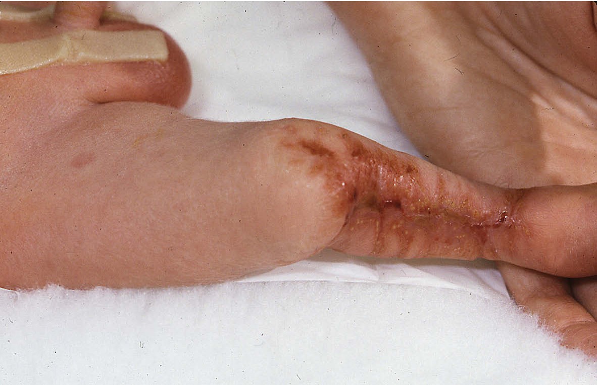 Trẻ mắc hội chứng thủy đậu bẩm sinh có thể gặp những bất thường về da và các bộ phận trên cơ thể