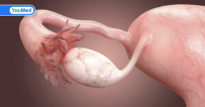 Tắc vòi trứng có chữa được không? Câu trả lời của bác sĩ