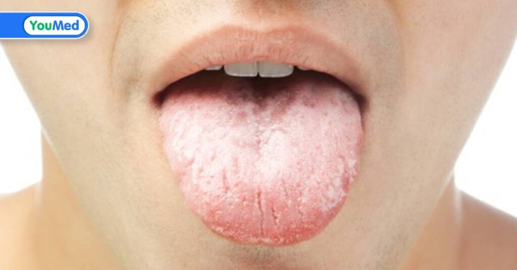 Ung thư lưỡi giai đoạn đầu: dấu hiệu và cách điều trị