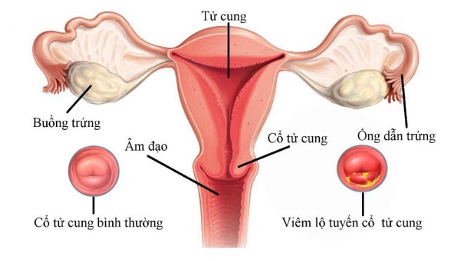 Viêm lộ tuyến cổ tử cung thường xuất hiện ở nữ giới trong độ tuổi sinh sản