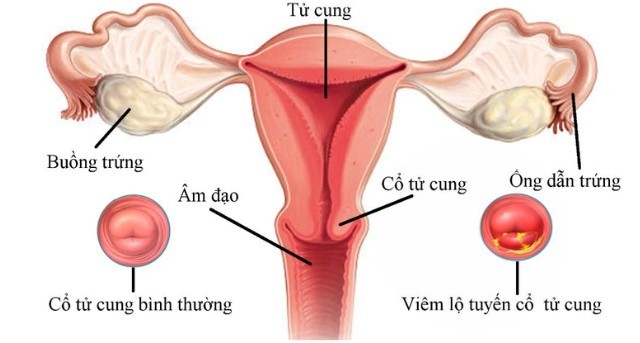 Cổ tử cung bình thường và cổ tử cung viêm lộ tuyến
