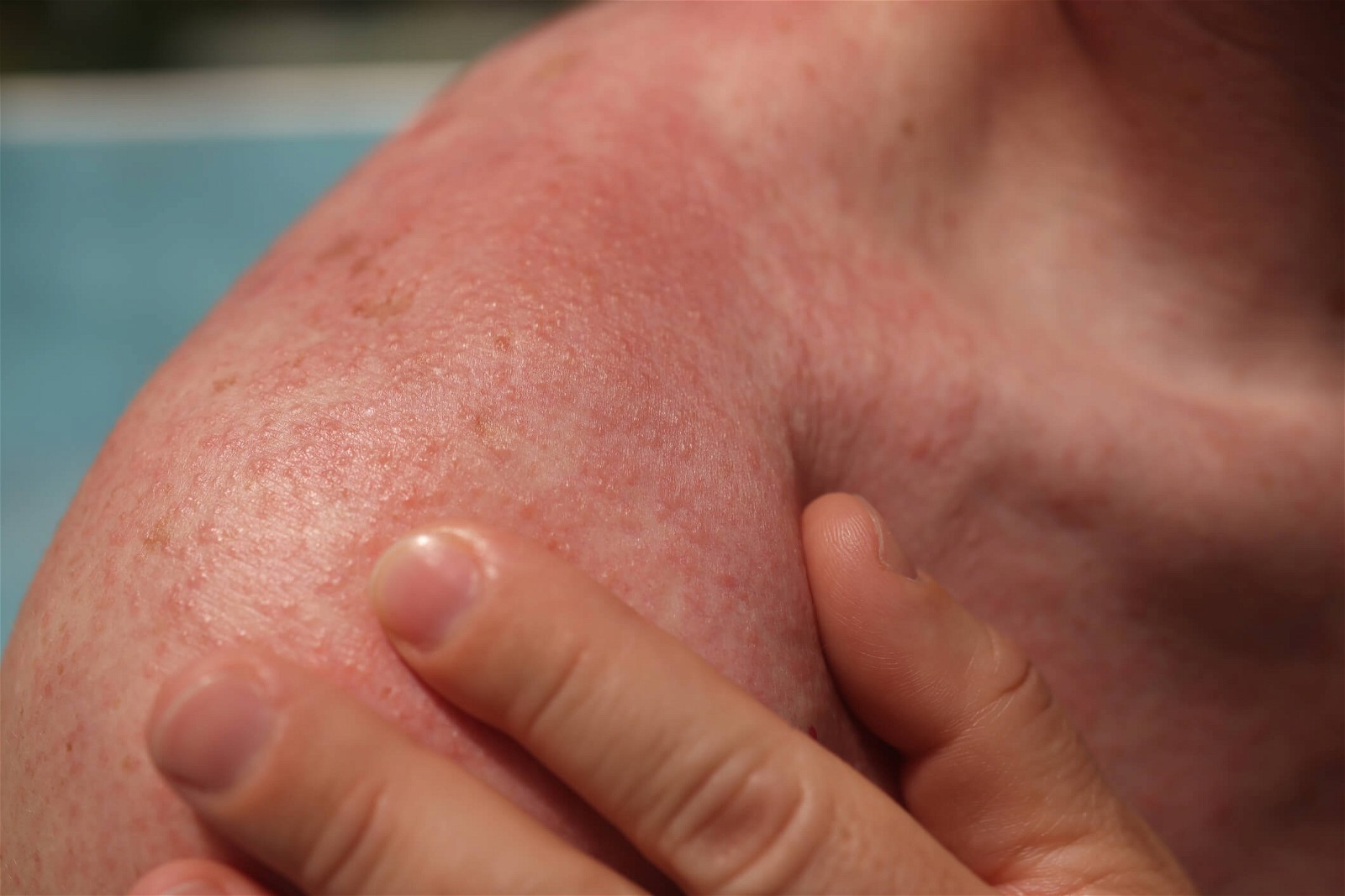 Vùng da được điều trị bằng xạ trị có thể có phản ứng đỏ rát sau xạ trị