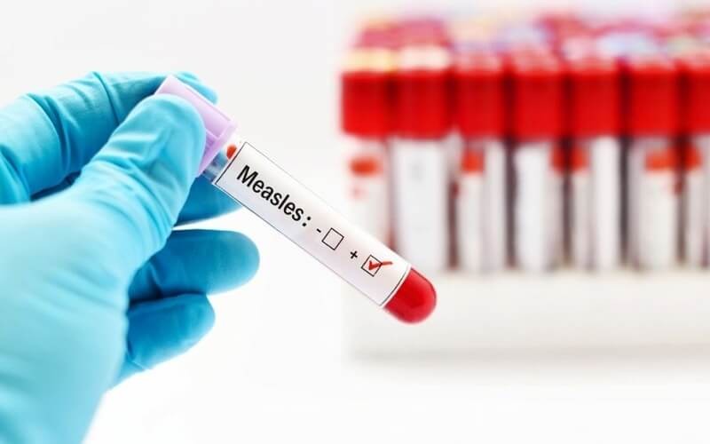 Mẫu máu xét nghiệm Measles IgM nên được lấy trong khoảng 3 đến 28 ngày sau khi phát ban