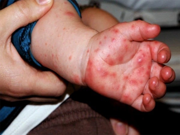 Cần phân biệt bệnh sởi với bệnh tay chân miệng do Enterovirus type 71