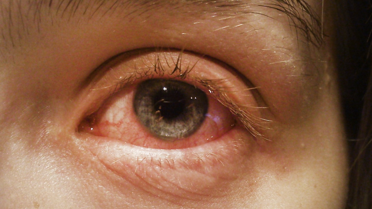 Đỏ, ngứa và cộm ở mắt là dấu hiệu của đau mắt đỏ