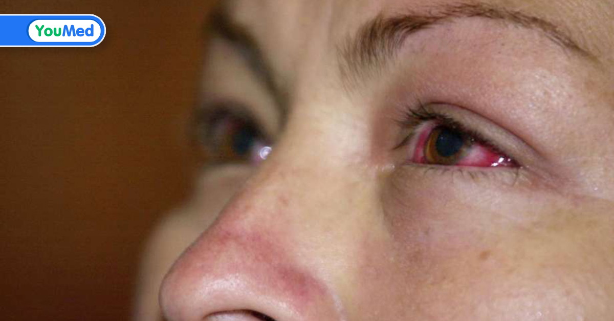 Có những yếu tố nào có thể gây ra đau mắt đỏ cho bà bầu?
