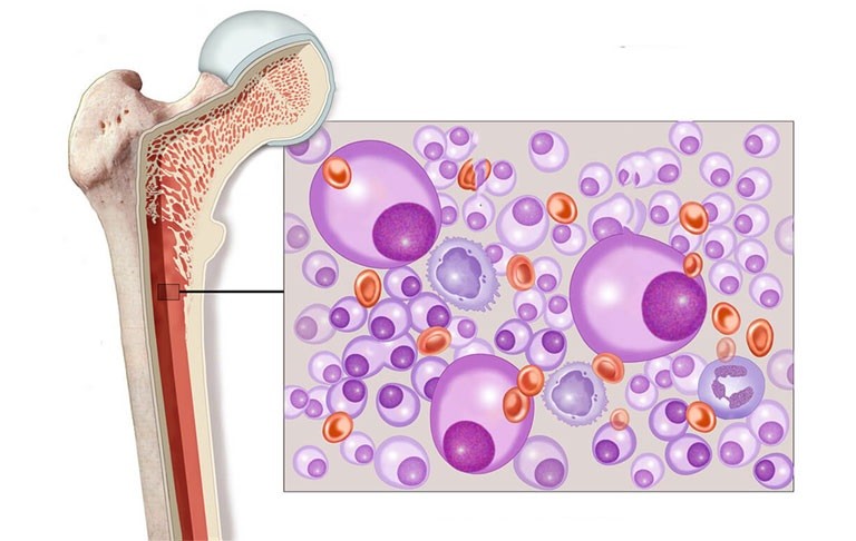 Tủy xương là nơi sản sinh ra các tế bào máu