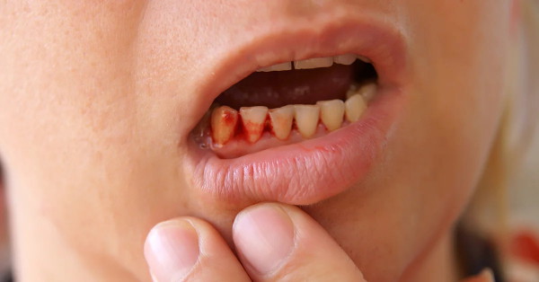 Chảy máu chân răng có thể là dấu hiệu của một số bệnh ung thư