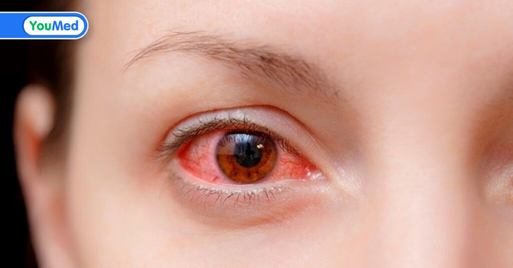 Đau mắt đỏ có lây không? Câu trả lời của bác sĩ