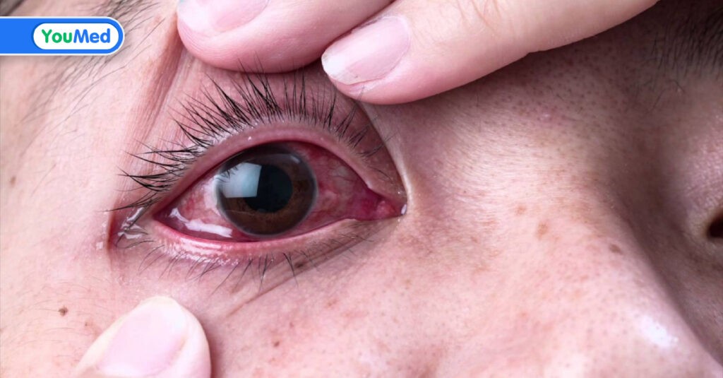 Đau mắt đỏ kiêng ăn gì và nên ăn gì để hỗ trợ nhanh khỏi bệnh?