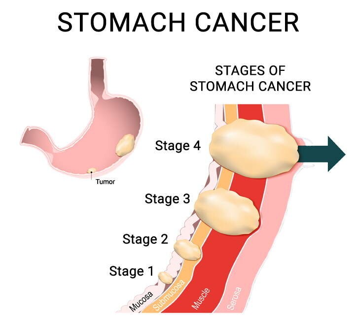 Các giai đoạn (stage) của ung thư dạ dày (stomach cancer)