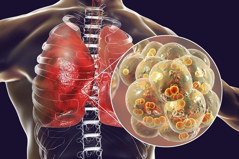 Viêm phổi là tình trạng phổi bị nhiễm trùng dẫn đến những triệu chứng khó chịu trên đường hô hấp