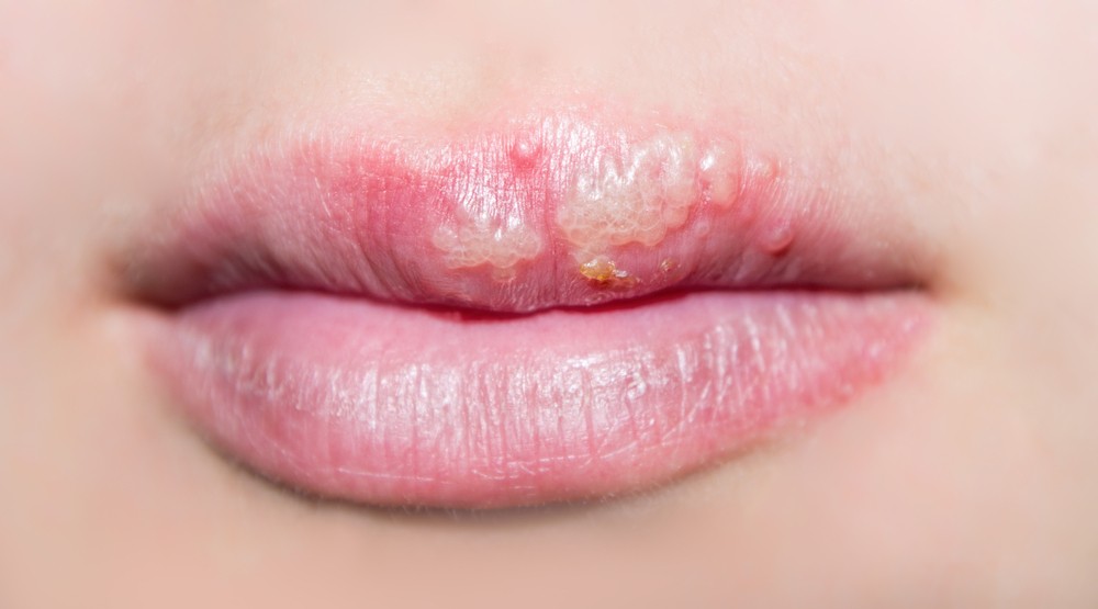 Thuốc Cloviracinob có thể được dùng để điều trị nhiễm virus Herpes Simplex ở môi