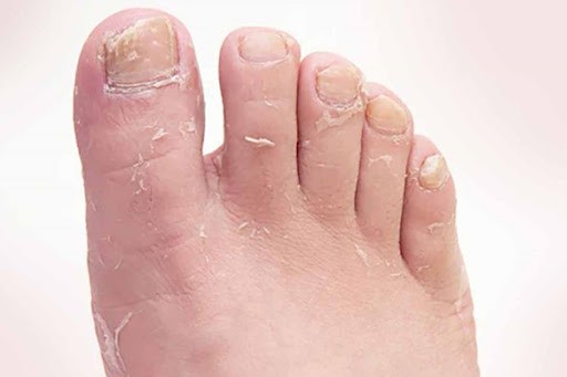 Comozol có thể được dùng để điều trị nấm da chân
