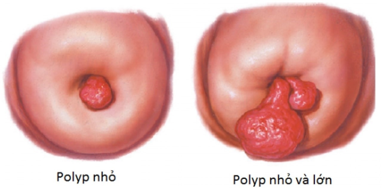Polyp cổ tử cung có thể khác nhau về kích thước tùy theo từng trường hợp