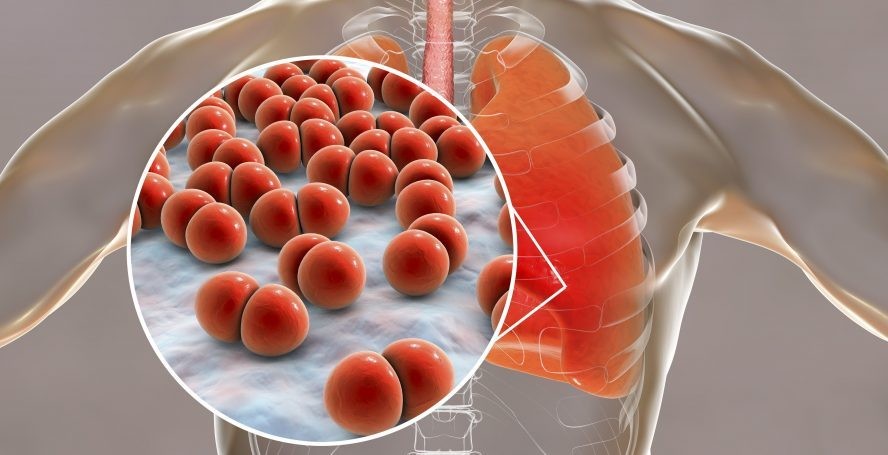 Viêm phổi và viêm phế quản là hai bệnh thường gặp ở đường hô hấp