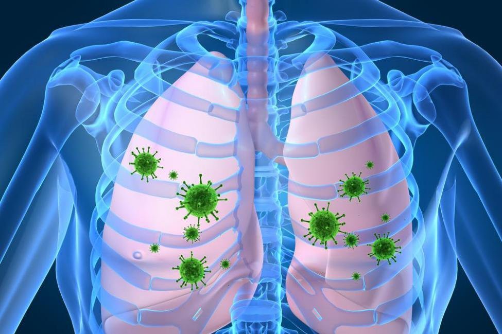 Viêm phổi do virus, vi khuẩn gây ra có thể lây truyền giữa người với người