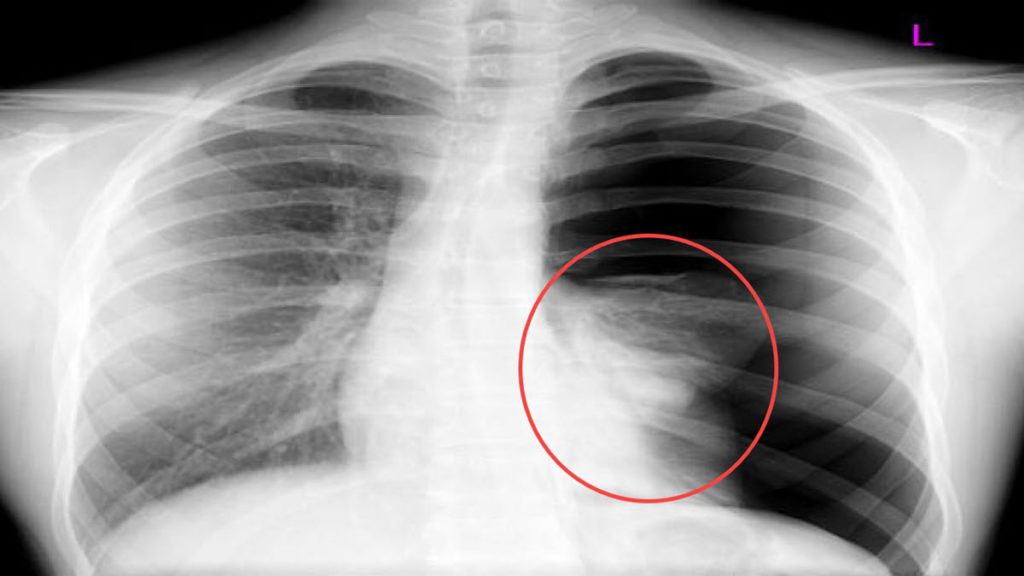 Tràn dịch màng phổi có thể xảy ra khi bị viêm phổi