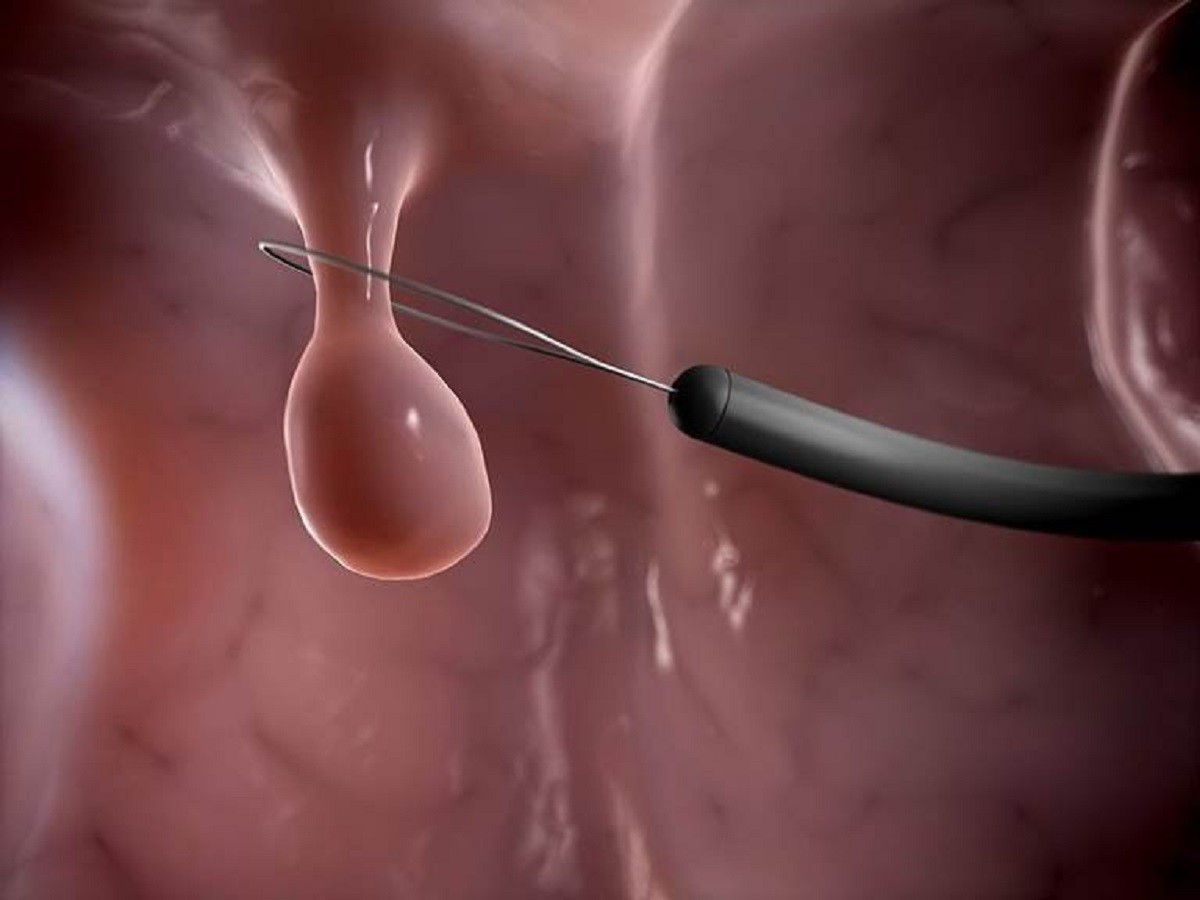 Xoắn và cắt là những phương pháp loại bỏ polyp cổ tử cung thường được sử dụng