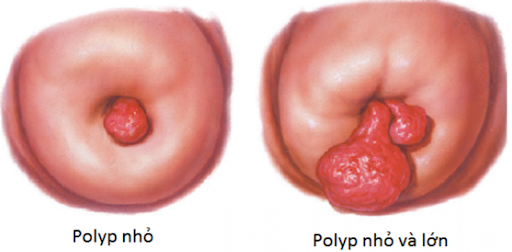 Khác nhau về kích thước của polyp cổ tử cung