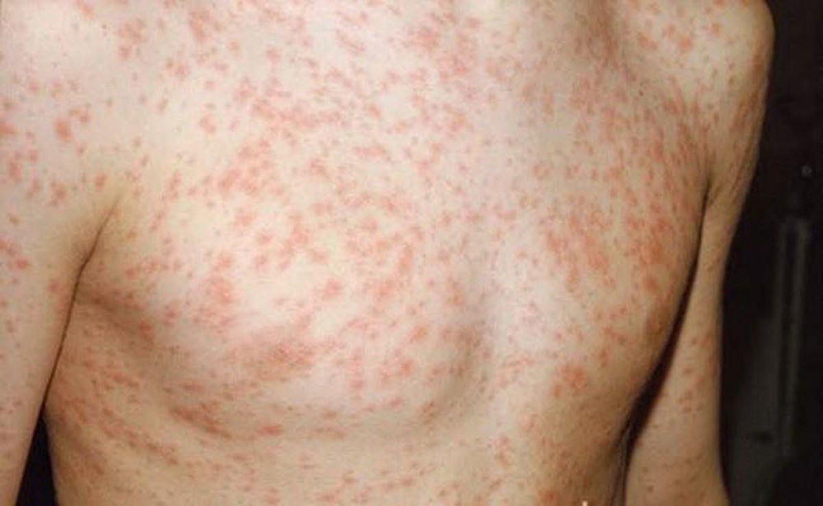 Sốt và phát ban trên cơ thể là hai triệu chứng chung của nhóm bệnh sốt phát ban