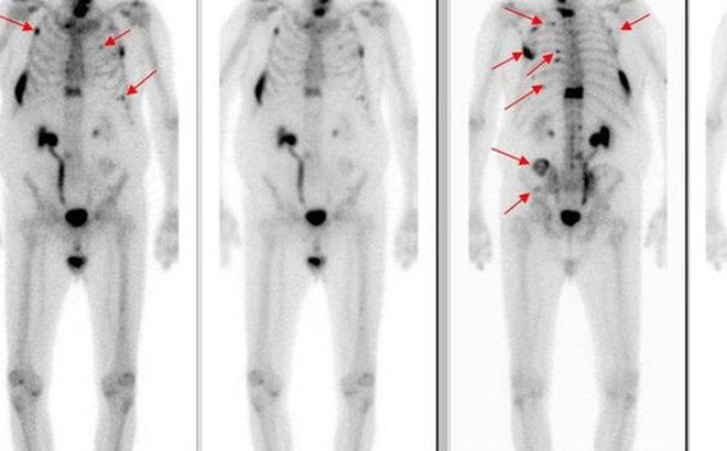 Các xét nghiệm hình ảnh giúp chẩn đoán ung thư di căn đến xương hay chưa