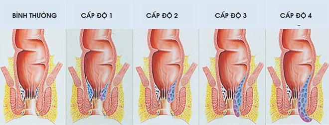 Các cấp độ của bệnh trĩ nội