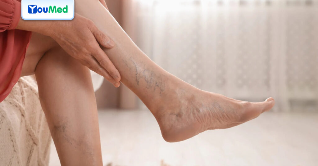 Bài tập và chế độ ăn của người suy giãn tĩnh mạch giúp đẩy lùi biến chứng hiệu quả