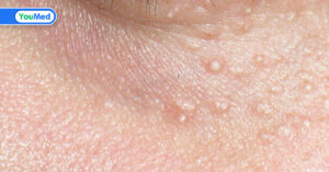 Điều trị u tuyến mồ hôi bằng laser