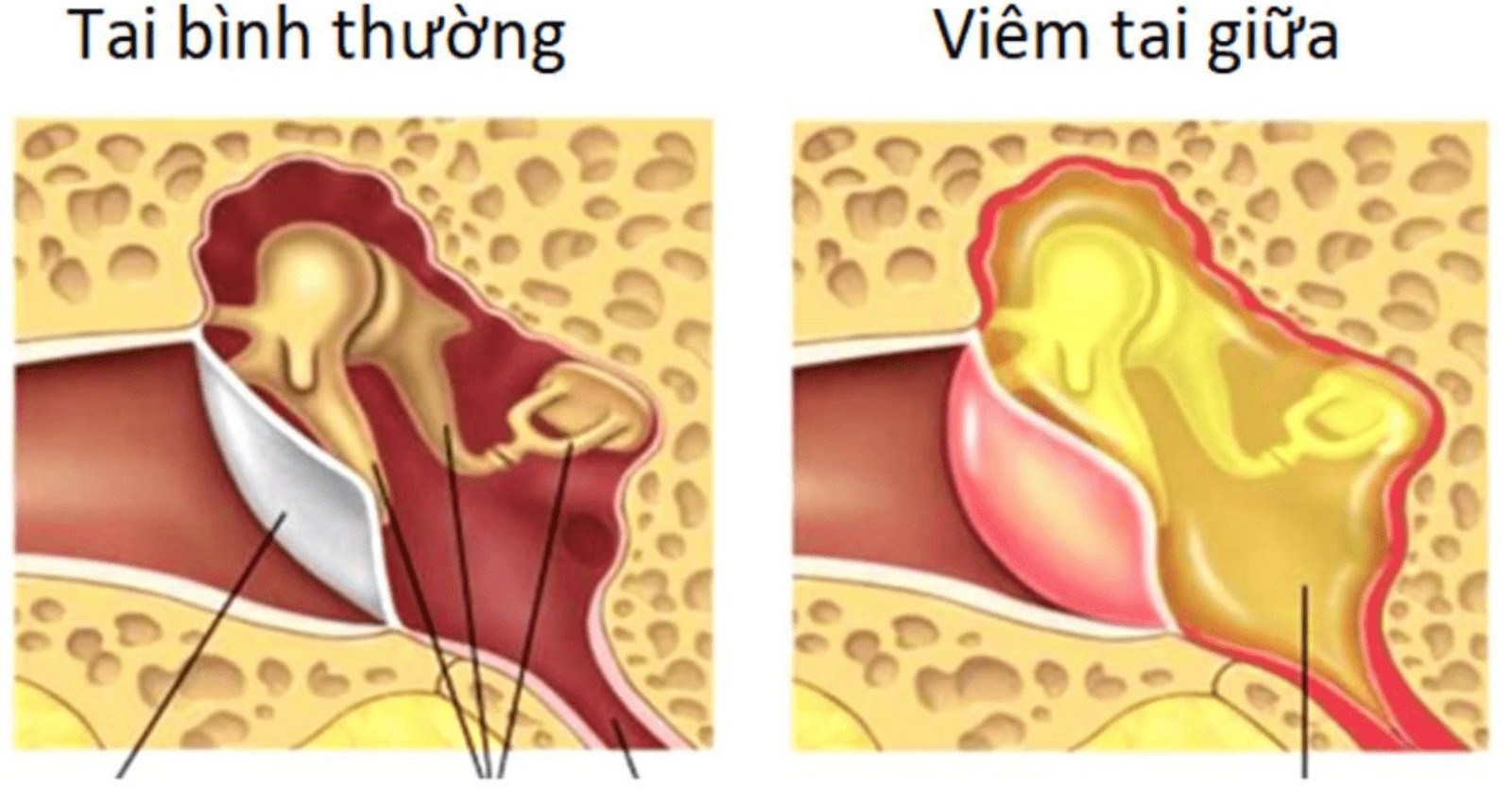 Phân biệt tai giữa bình thường và viêm tai giữa