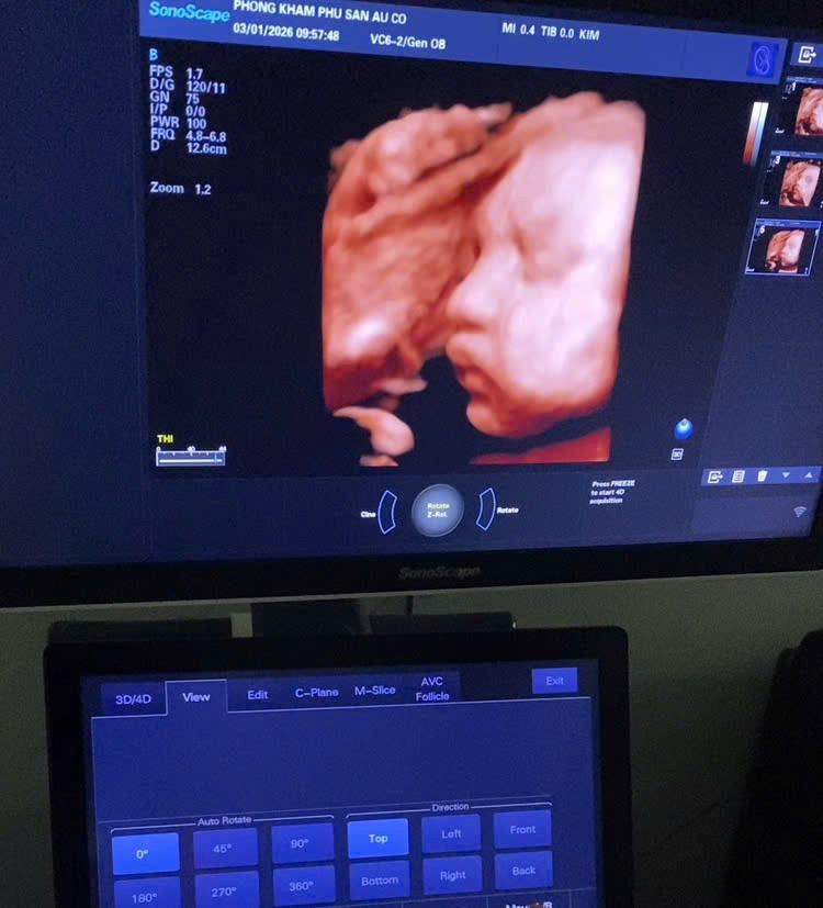 Hình chụp siêu âm tại phòng khám phục sản IVF Âu Cơ