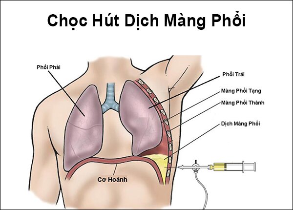 Chọc dịch màng phổi: Quy trình, chỉ định và những lưu ý quan trọng 3 Chọc dịch màng phổi được thực hiện theo quy trình đảm bảo an toàn cho người bệnh
